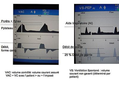 Le respirateur en anesthésie et les modes ventilatoires, les filtres  antibactériens - [Société Française des Infirmier(e)s Anesthésistes]